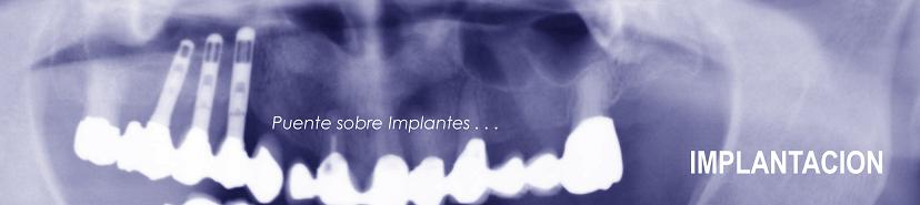 Puente sobre implantes